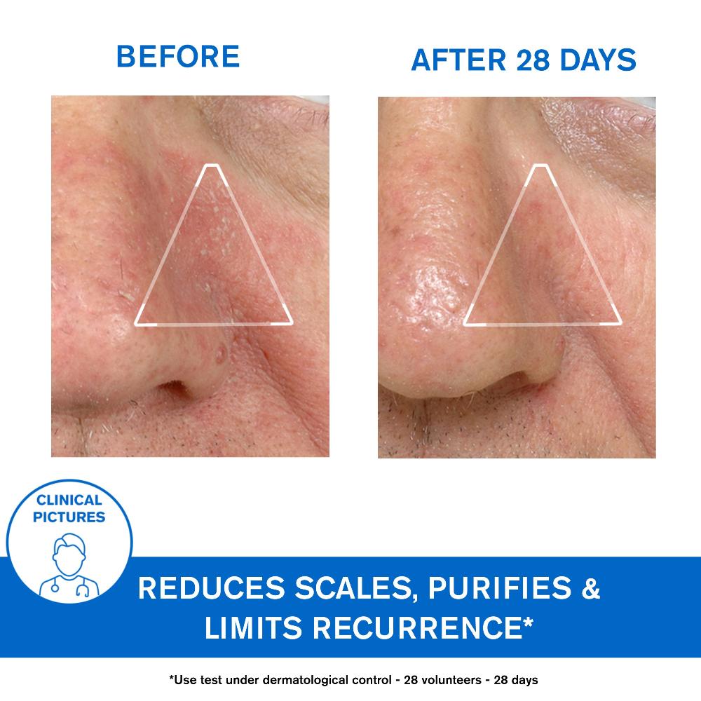 Uriage D.S. Regulating Emulsion, Irritation, Redness, Scales 40ml