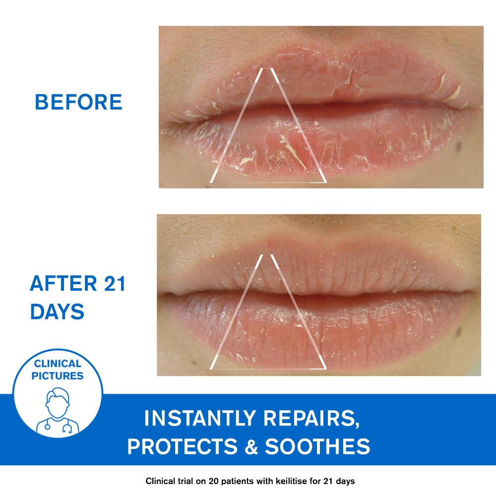 Uriage D.S. Regulating Emulsion, Irritation, Redness, Scales 40ml